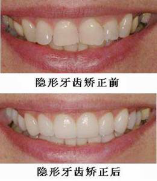 假牙怎么保养价格区别图,假牙怎样清洗(图1)